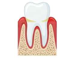 Gingivitis