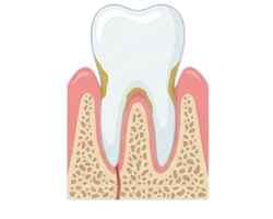 Mild Periodontitis