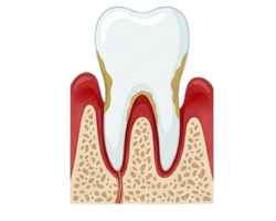 Moderate Periodontitis